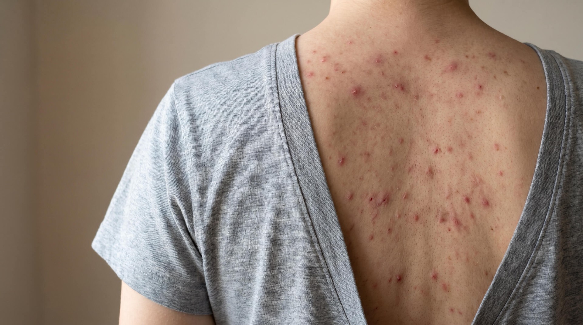 Body Acne: Why Your Back and Chest Break Out Differently Than Your Face
