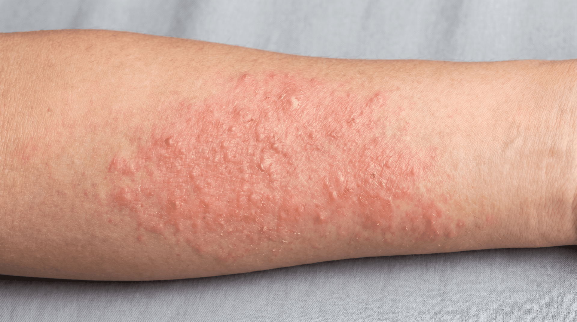 Contact Dermatitis: How to Tell If Your Skincare Is Actually Hurting You