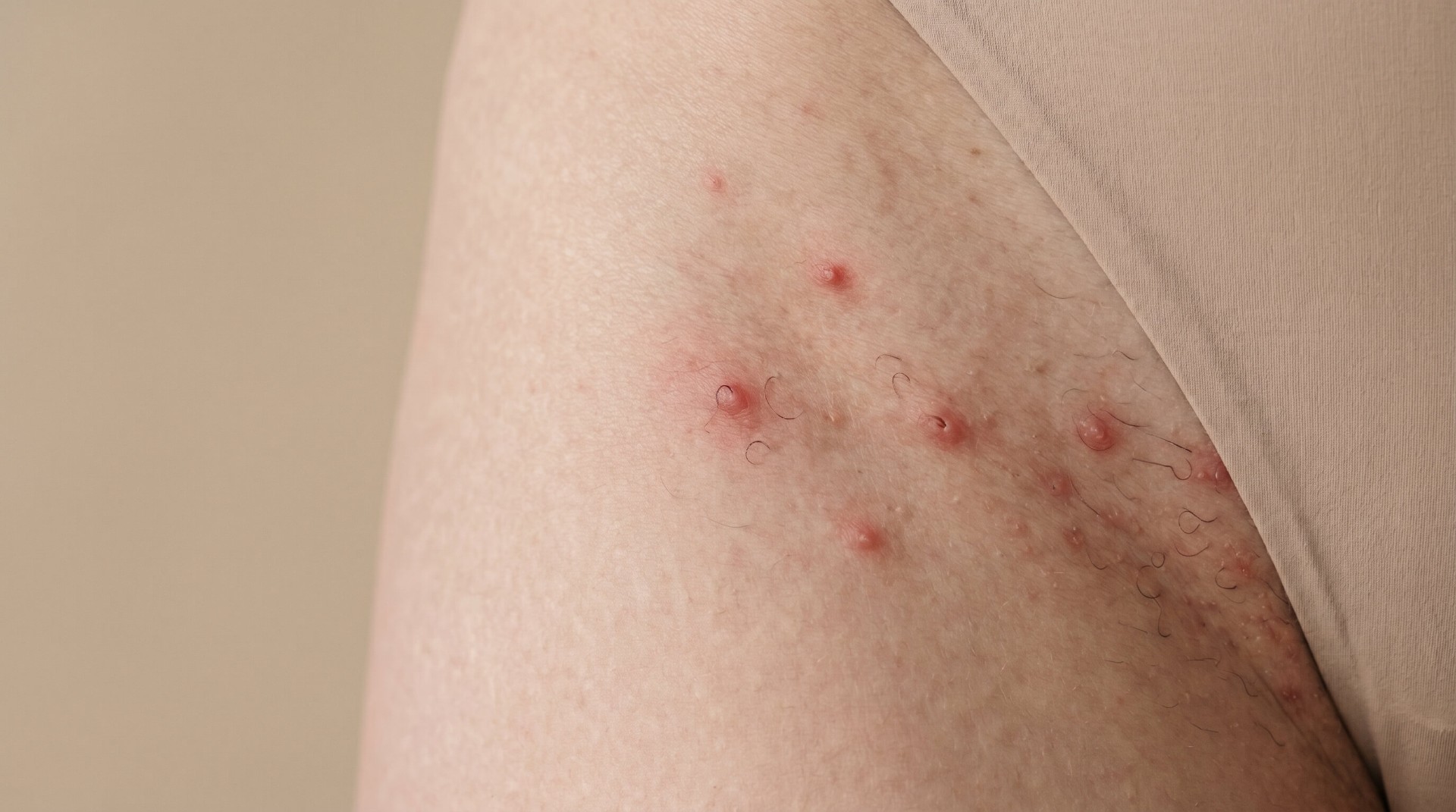Ingrown Hairs: Why They Happen and How to Prevent and Treat Them